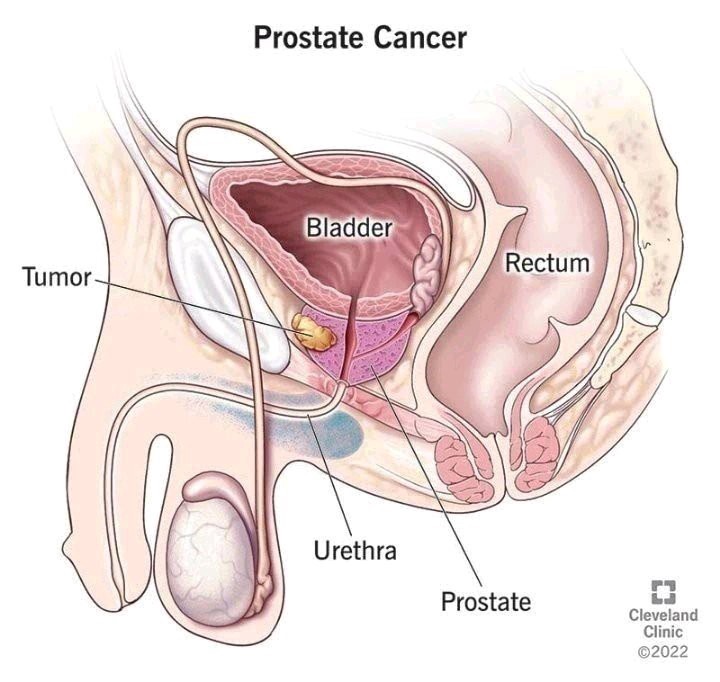 Cancer Prostate